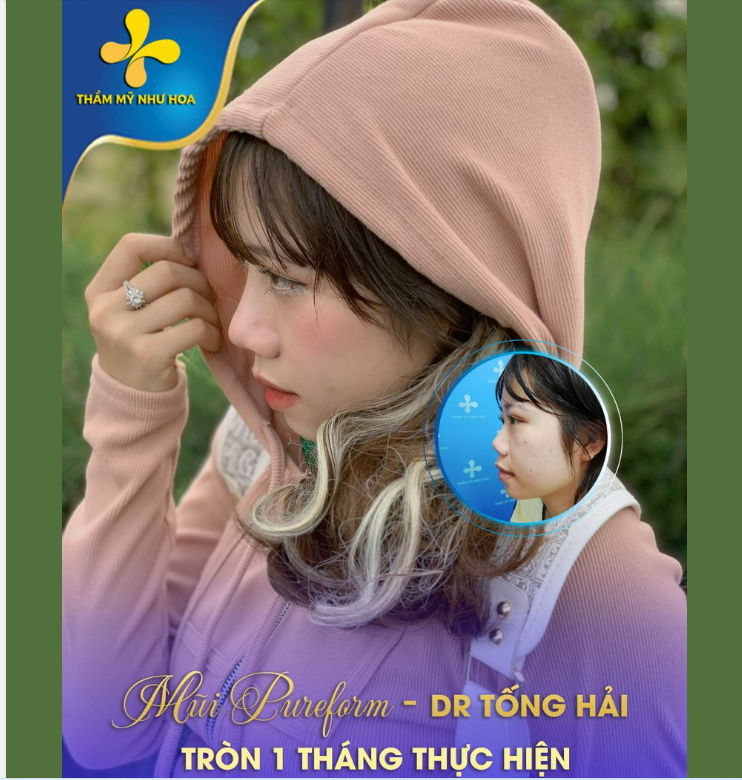 NÂNG MŨI PUREFORM TẠI BÁC SĨ TỐNG HẢI SAU 1 THÁNG TRÔNG SẼ NHƯ THẾ NÀO