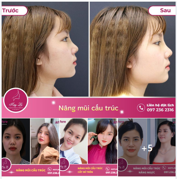 NÂNG MŨI SIÊU CẤU TRÚC - MŨI CAO ĐẸP HẾT Ý VỚI CHI PHÍ NHƯ MƠ