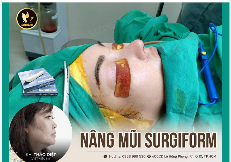 NÂNG MŨI SURGIFORM – LỰA CHỌN HÀNG ĐẦU CỦA KHÁCH HÀNG TẠI SAIGON STAR