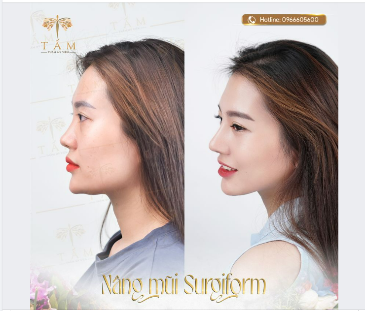 Nâng mũi Surgiform tại Thẩm mỹ viện Tấm