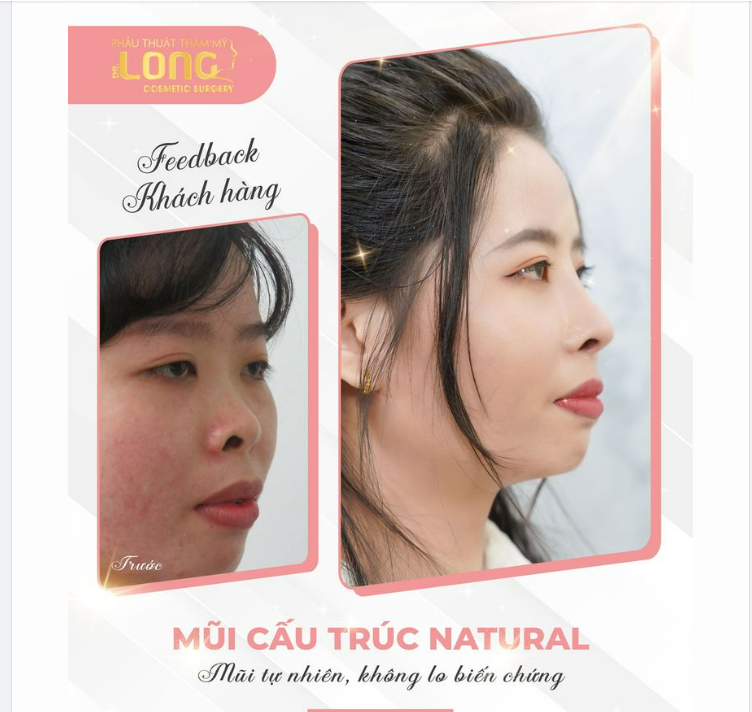 Nâng mũi tại TMV Bác sĩ Long