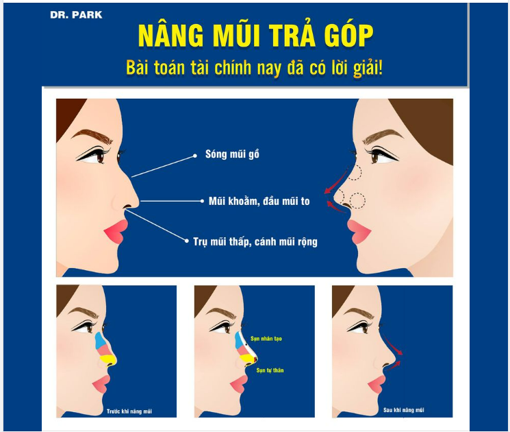 NÂNG MŨI TRẢ GÓP - BÀI TOÁN TÀI CHÍNH NAY ĐÃ CÓ LỜI GIẢI