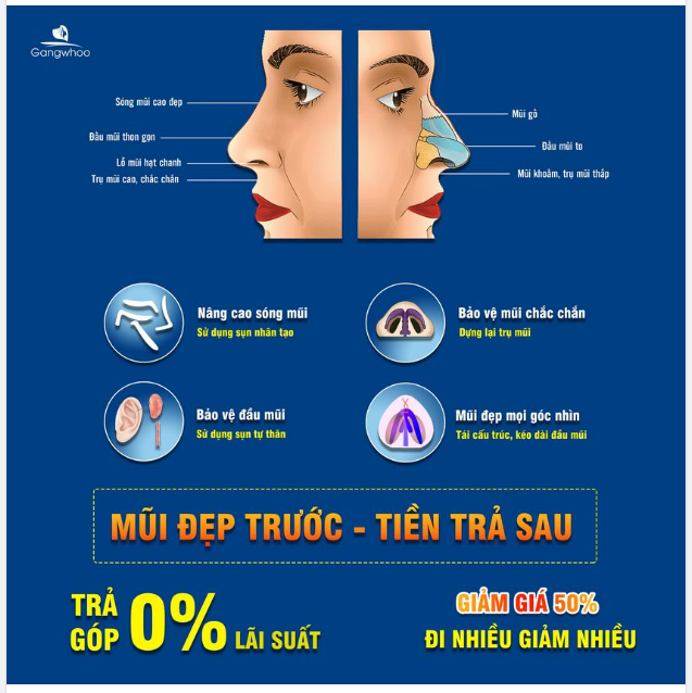 NÂNG MŨI TRẢ GÓP - MŨI ĐẸP TRƯỚC - TRẢ TIỀN SAU