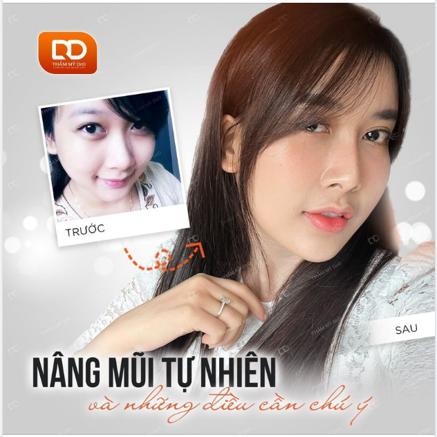 NÂNG MŨI TỰ NHIÊN VÀ NHỮNG ĐIỀU CẦN LƯU Ý