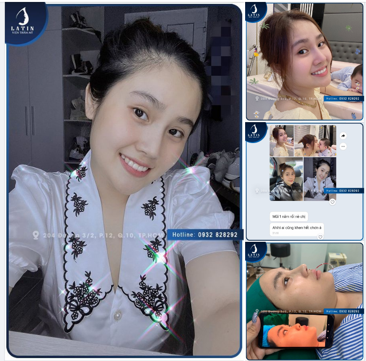 Nâng mũi xong ai cũng khen xinh luôn ấy. Cảm ơn Latin nhiều lắm ạ!