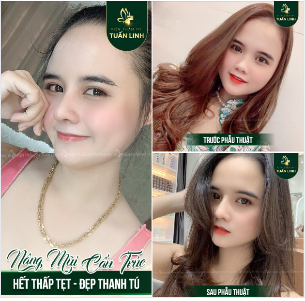NÂNG MŨI XONG THẦN THÁI KHÁC BIỆT LIỀN NHA CÁC NÀNG ƠI 