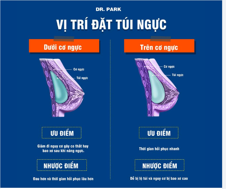 NÂNG NGỰC - TÚI NGỰC SẼ ĐẶT Ở VỊ TRÍ NÀO