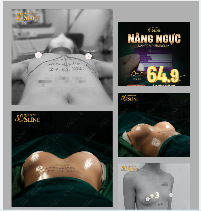 Nâng ngực Nanochip Ergonomix(dòng túi cao cấp nhất)