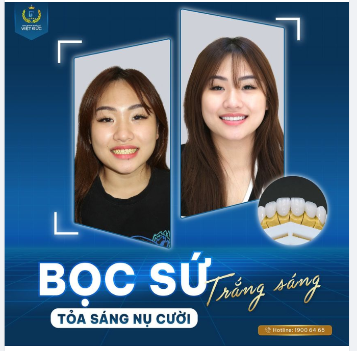 NÂNG TẦM NỤ CƯỜI NHỜ BỌC SỨ NANO CERAMIC