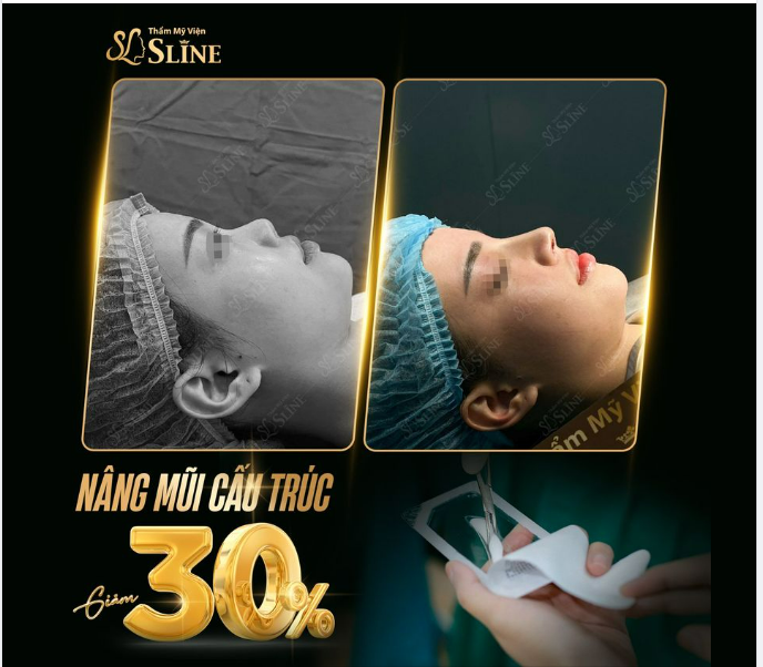 NÂNG MŨI  CẤU TRÚC.