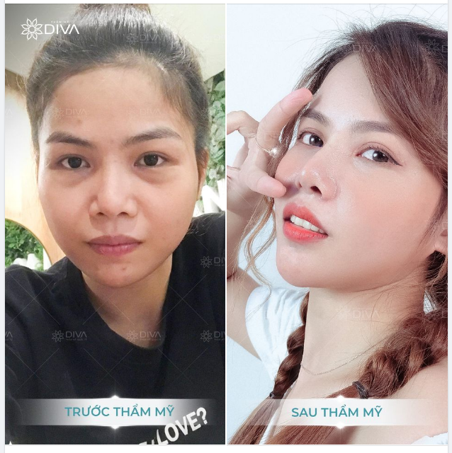 NÊN ƯU TIÊN LOẠI BỎ TÚI MỠ MÍ DƯỚI VÌ SAO