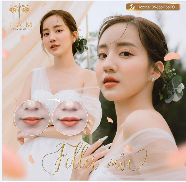 Nét đẹp không thể rời mắt với Filler Môi