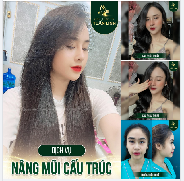 Nếu không thử đi nâng mũi bạn sẽ không biết gương mặt bạn sẽ thay đổi như thế nào đâu