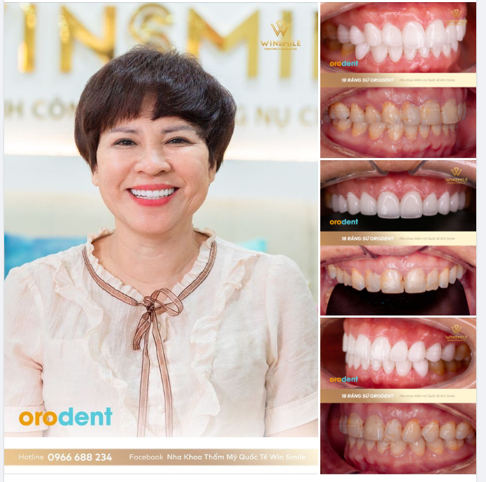 NGẢ MŨ TRƯỚC NỮ HOÀNG ORODENT - DÒNG SỨ “ĐẮT ĐỎ” NHẤT TRONG PHÂN KHÚC CAO CẤP