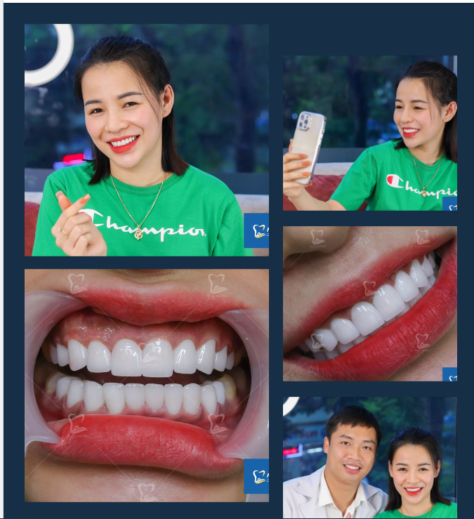 Ngắm nhìn nụ cười rạng rỡ của chị Lê Hiền tại Nha khoa sau 72h, thay đổi nào làm bạn thấy ấn tượng nhất?