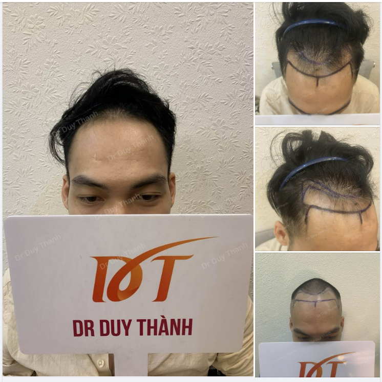 NGÀY CUỐI TUẦN CHUẨN BỊ CẤY 1600 NANG CHO BOY HCM 27 TUỔI