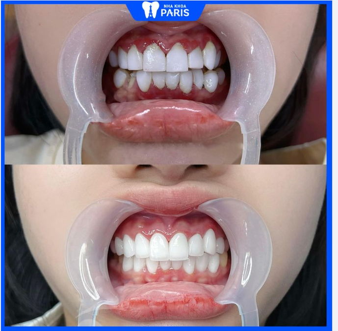 Ngày Nha khoa Paris tìm lại nụ cười cho em là ngày em hạnh phúc nhất