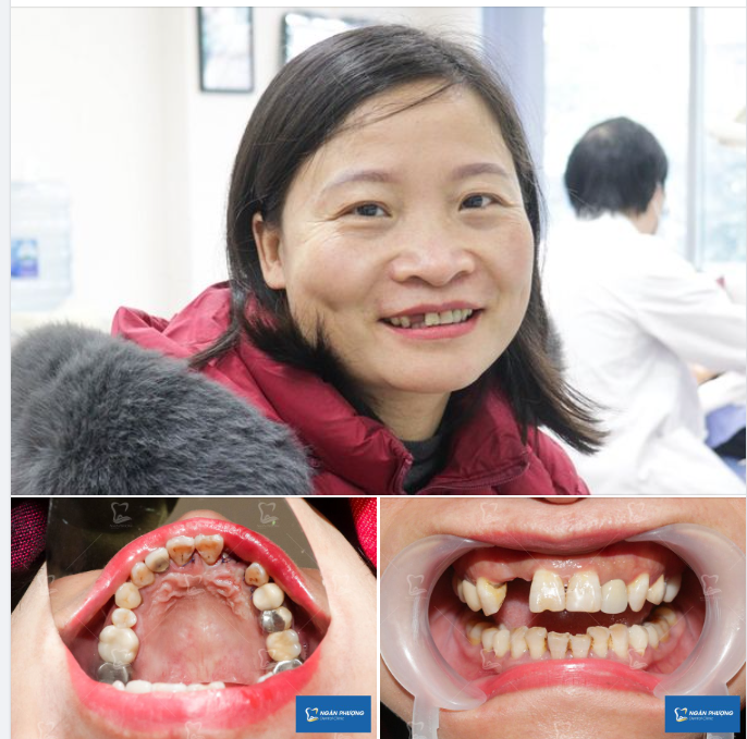 Nghe xong 2 bài hát là đã cắm xong trụ implant rồi