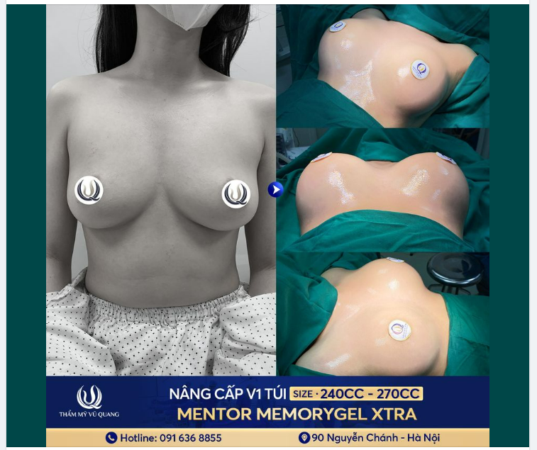 Ngực lệch - sa trễ do cơ địa có khắc phục được không