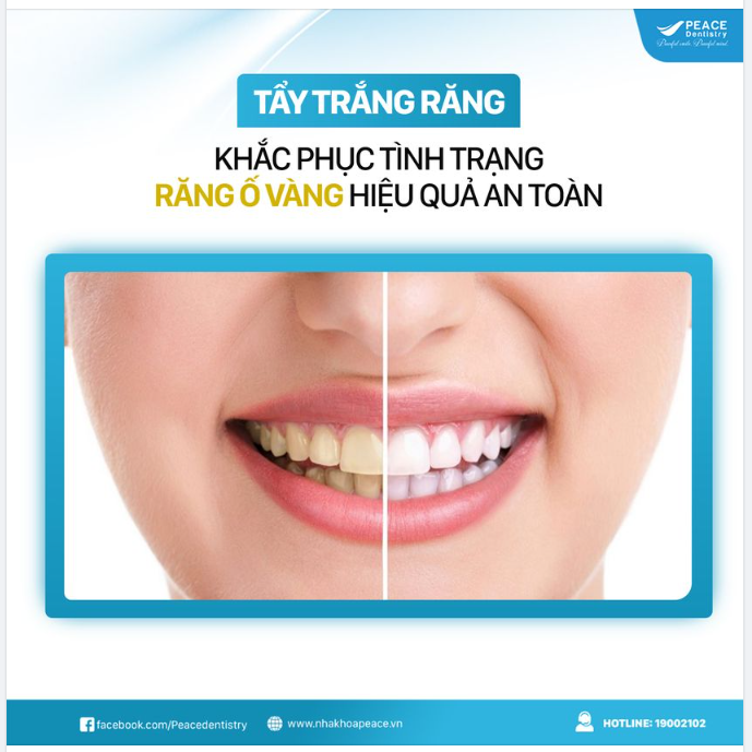Nguyên nhân khiến răng bạn ố vàng  cách khắc phục hiệu quả
