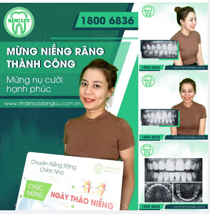 Nha Khoa Đăng Lưu chúc mừng bạn tháo niềng