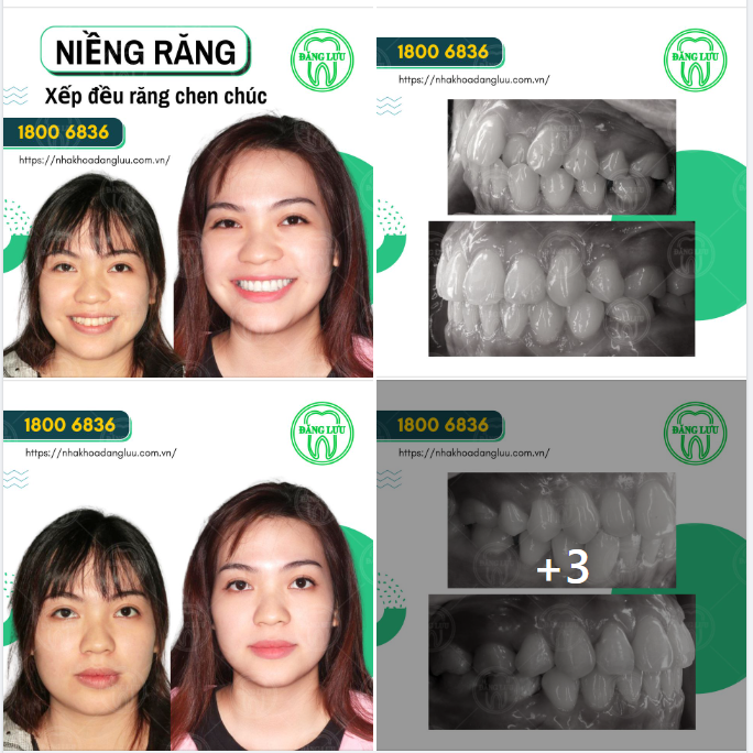 Nha Khoa Đăng Lưu mừng bạn niềng răng thành công!