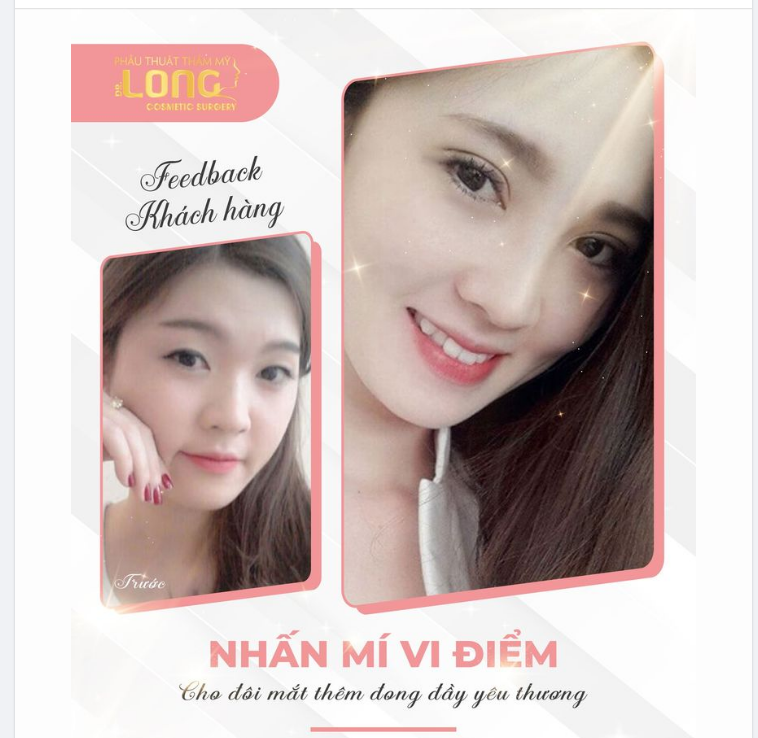 NHẤN MÍ VI ĐIỂM MẮT 2 MÍ ĐẸP XINH KHÔNG CẦN PHẪU THUẬT