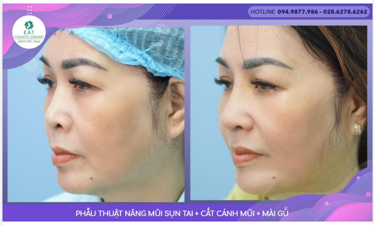 Nhẹ nhàng - nhanh chóng - đẹp theo chuẩn từng gương mặt