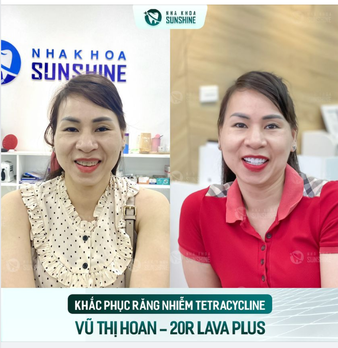 Nhiễm kháng sinh răng sẽ tối màu từ bên trong mô răng, vì thế làm mất thẩm mỹ cho người bệnh.