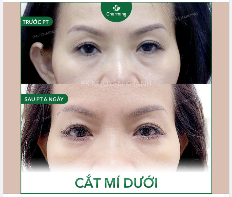 Nhiều chị em sở hữu mí trên rất xinh đẹp tuyệt vời nhưng vẫn thấy không ổn do mí dưới có quá nhiều bọng mỡ và da chùng.