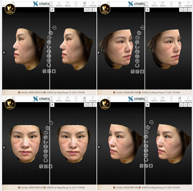 NHÌN TRƯỚC DÁNG MŨI CÙNG CÔNG NGHỆ CRISALIX 3D