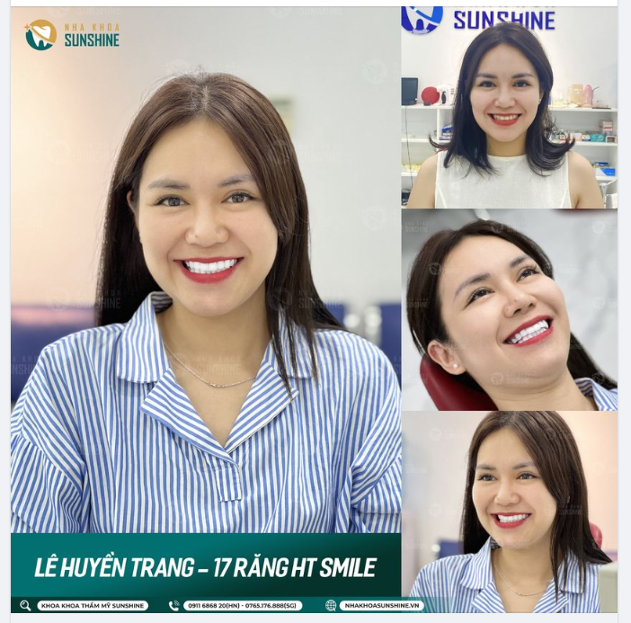Nhờ công nghệ độc quyền Super Ultra Thin, Chỉ sau 48H, Sunshine đã giúp khách hàng đánh bay các khuyết điểm