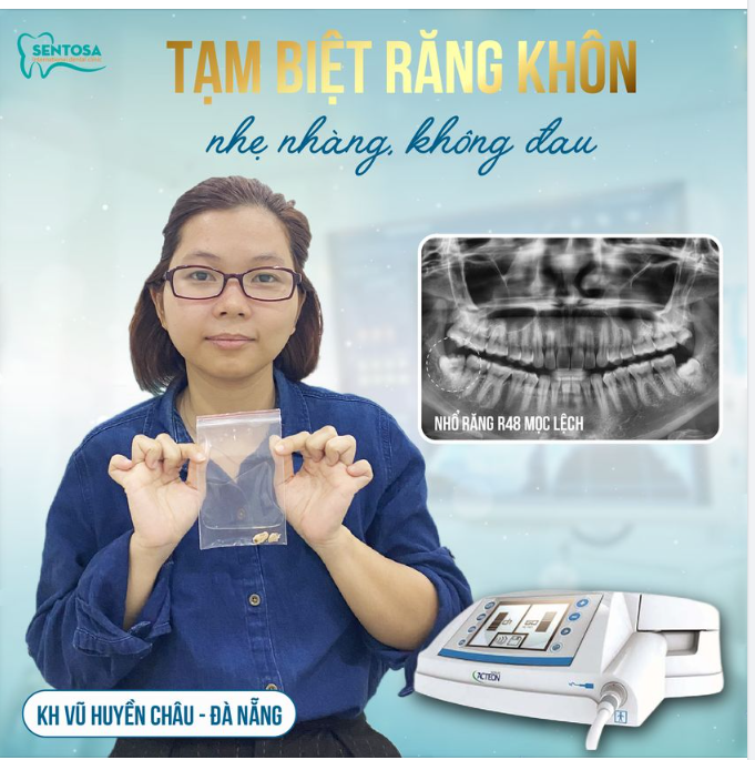 NHỔ RĂNG KHÔN KHÔNG ĐAU AN TOÀN, NHANH CHÓNG TẠI NHA KHOA SENTOSA