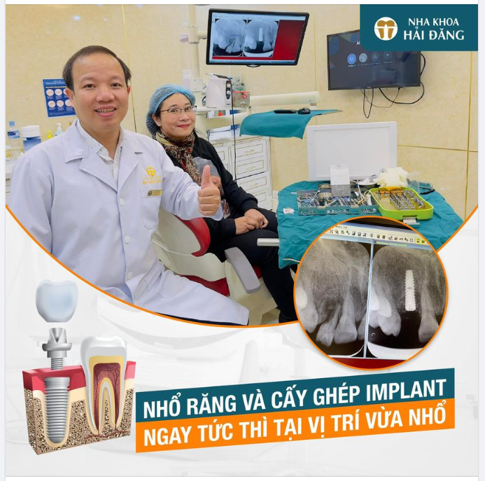 NHỔ RĂNG VÀ CẤY GHÉP IMPLANT NGAY TỨC THÌ TẠI VỊ TRÍ VỪA NHỔ