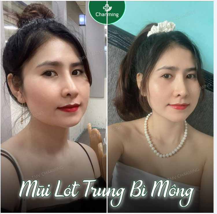 Những ai đã nâng mũi sụn nhân tạo  lót sụn mà lộ chóp nhiều nhìn vào feedback này là mê liền đấy nhé.