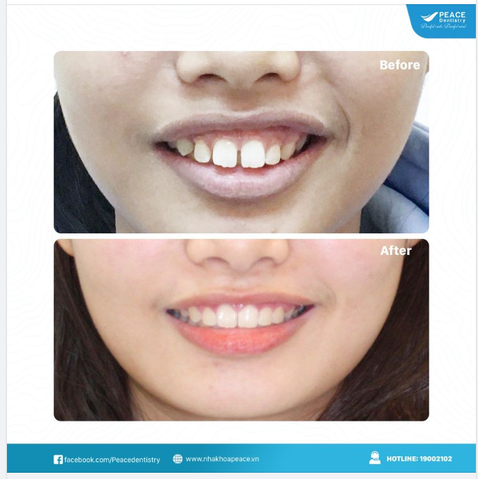 NIỀNG RĂNG CÓ THAY ĐỔI KHUÔN MẶT HAY KHÔNG? VÀ THAY ĐỔI NHƯ THẾ NÀO?