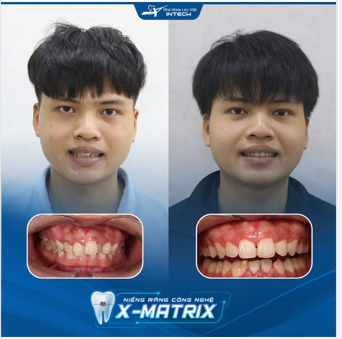 NIỀNG RĂNG CÔNG NGHỆ X-MATRIX XÓA BỎ RĂNG HÔ, KHẤP KHỂNH SAU 15 THÁNG