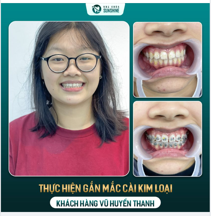 NIỀNG RĂNG GIÁ SINH VIÊN