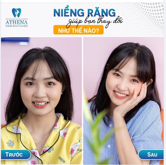 NIỀNG RĂNG GIÚP BẠN THAY ĐỔI NHƯ THẾ NÀO?