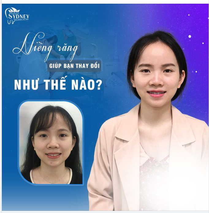 Niềng răng giúp bạn thay đổi như thế nào?