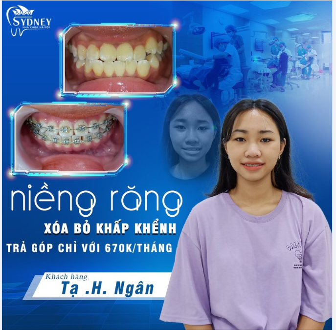Niềng răng khấp khểnh hiệu quả thế nào?