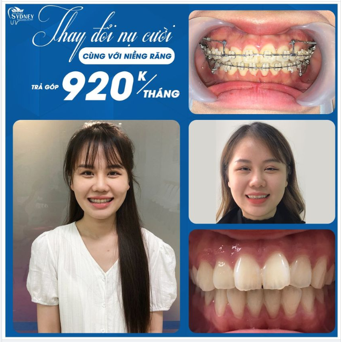 Niềng răng mắc cài pha lê – Thẩm mỹ và hiệu quả