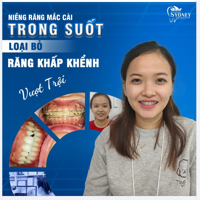 Niềng răng mắc cài trong suốt – Loại bỏ răng khấp khểnh