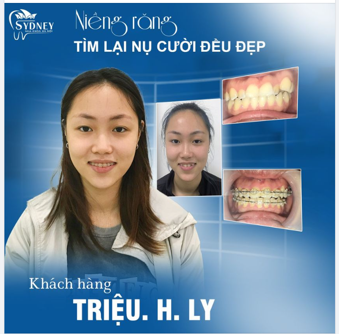 Niềng răng tìm lại nụ cười đẹp