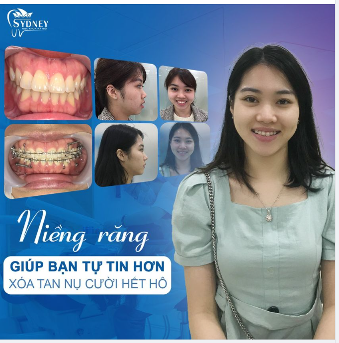 Niềng răng xóa tan nụ cười hô