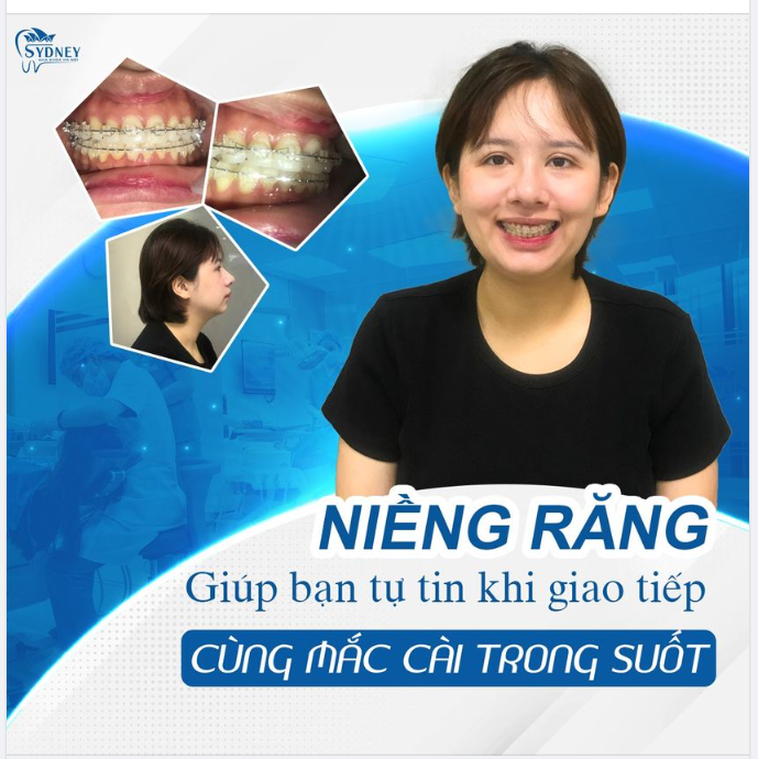 Niềng sớm đẹp sớm – Không bây giờ thì bao giờ?