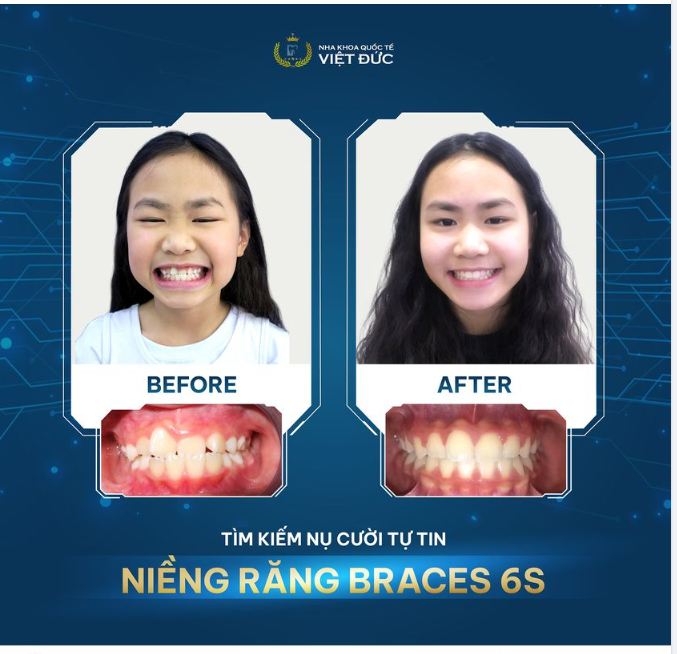 NIỀNG SỚM SỚM - VÔ VÀN LỢI ÍCH CHO TRẺ!