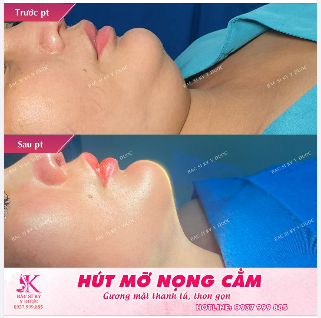 NỌNG CẰM BIẾN MẤT CHỈ SAU 45 PHÚT TẠI BS KỲ1 Y DƯỢC