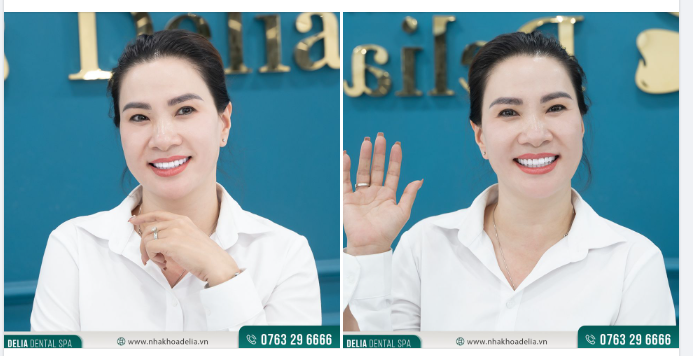  Nụ cười rạng rỡ của chị Thu Hiền sau thẩm mỹ răng sứ tại Delia.
