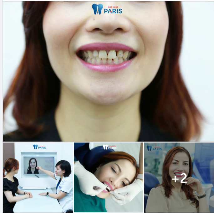 Ở Đức, 3000$/1 RĂNG SỨ, làm trọn bộ 20 răng mất đến 1,4 TỶ ĐỒNG